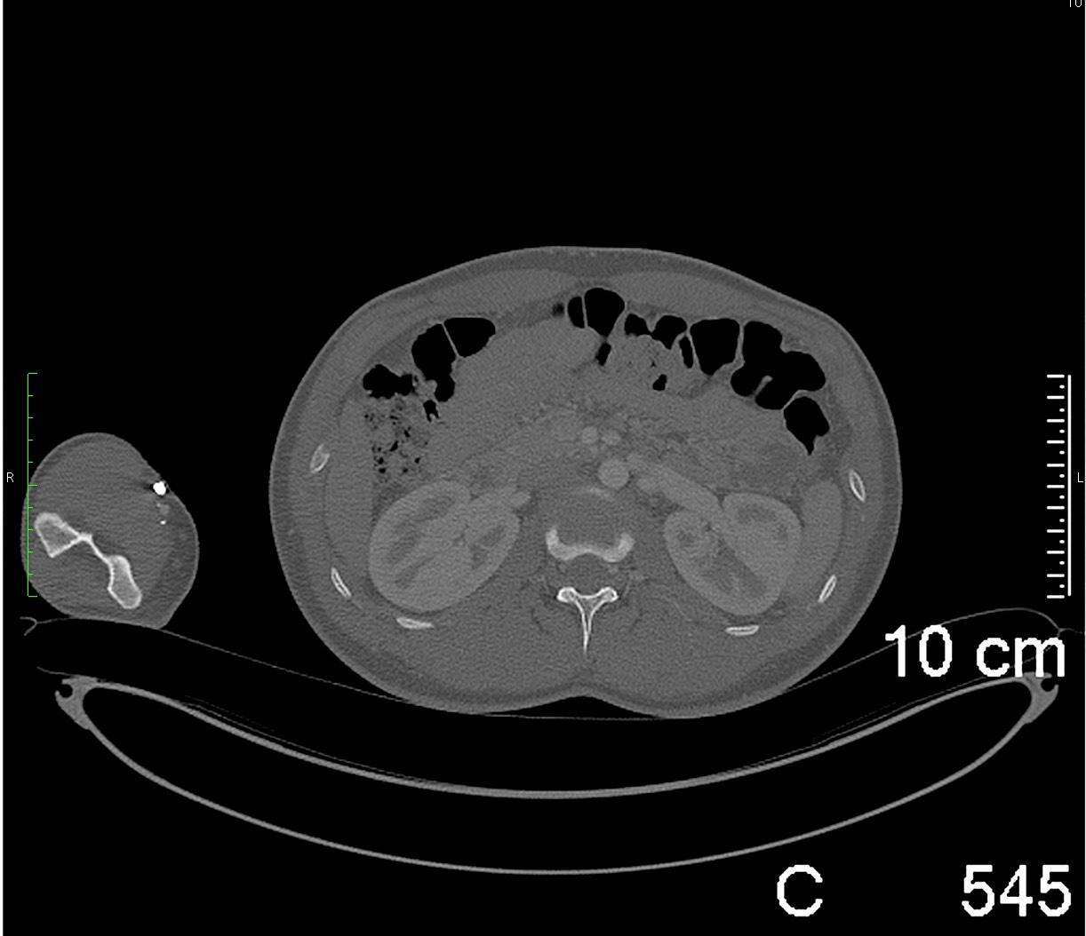 RACHIS%20DORSO%20LOMB%201.5MM